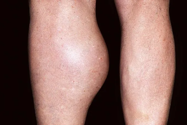 A baker's cyst may form behind the knee due to injury or arthritis. 