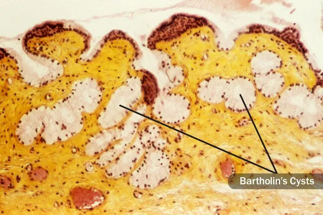 Bartholin cysts occur under the skin on either side of the vagina. 