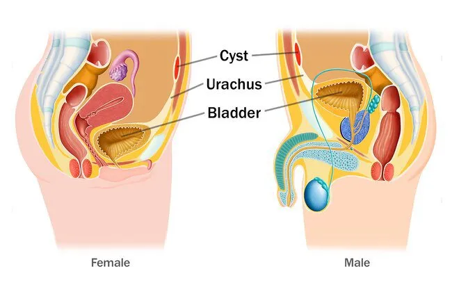 If the urachus doesn't close it may lead to a urachal cyst. 