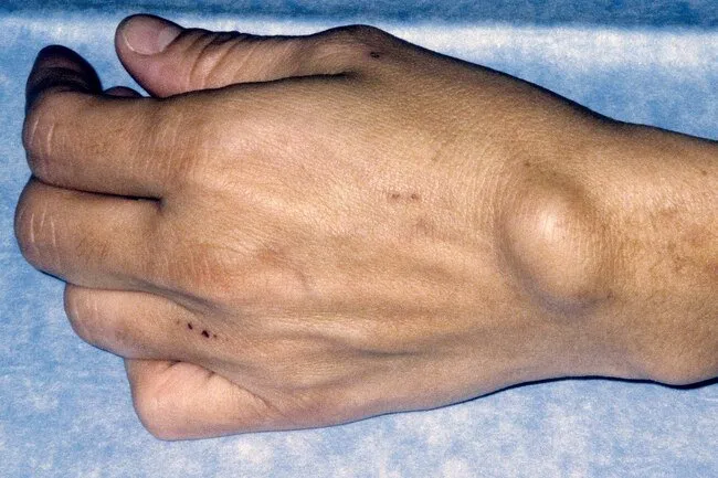 Ganglion cysts are filled with fluid near joints or tendons on the wrist or fingers.