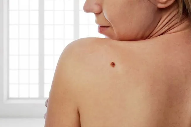 Skin cancer is almost always curable if you catch it early.