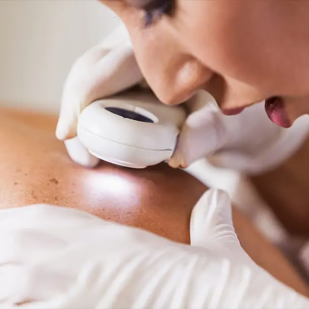 A skin biopsy is used to diagnose skin conditions, including skin cancer, by removing a piece of skin for further examination.