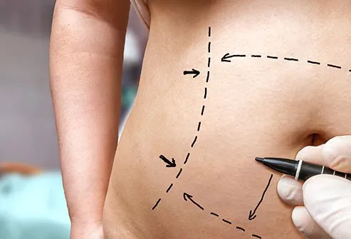 Liposuction doesn't reach inside the abdominal wall.