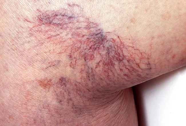 Picture of Spider Veins