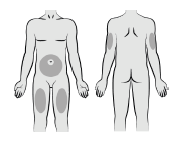 Choose and prepare the injection site - Illustration