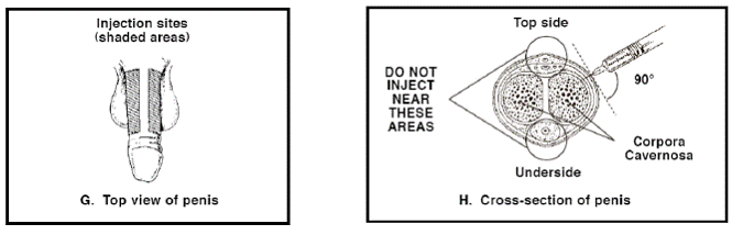 Remove the syringe cap - Illustration