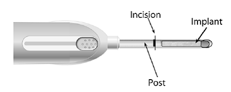 Depress the button to release the locking mechanism - Illustration