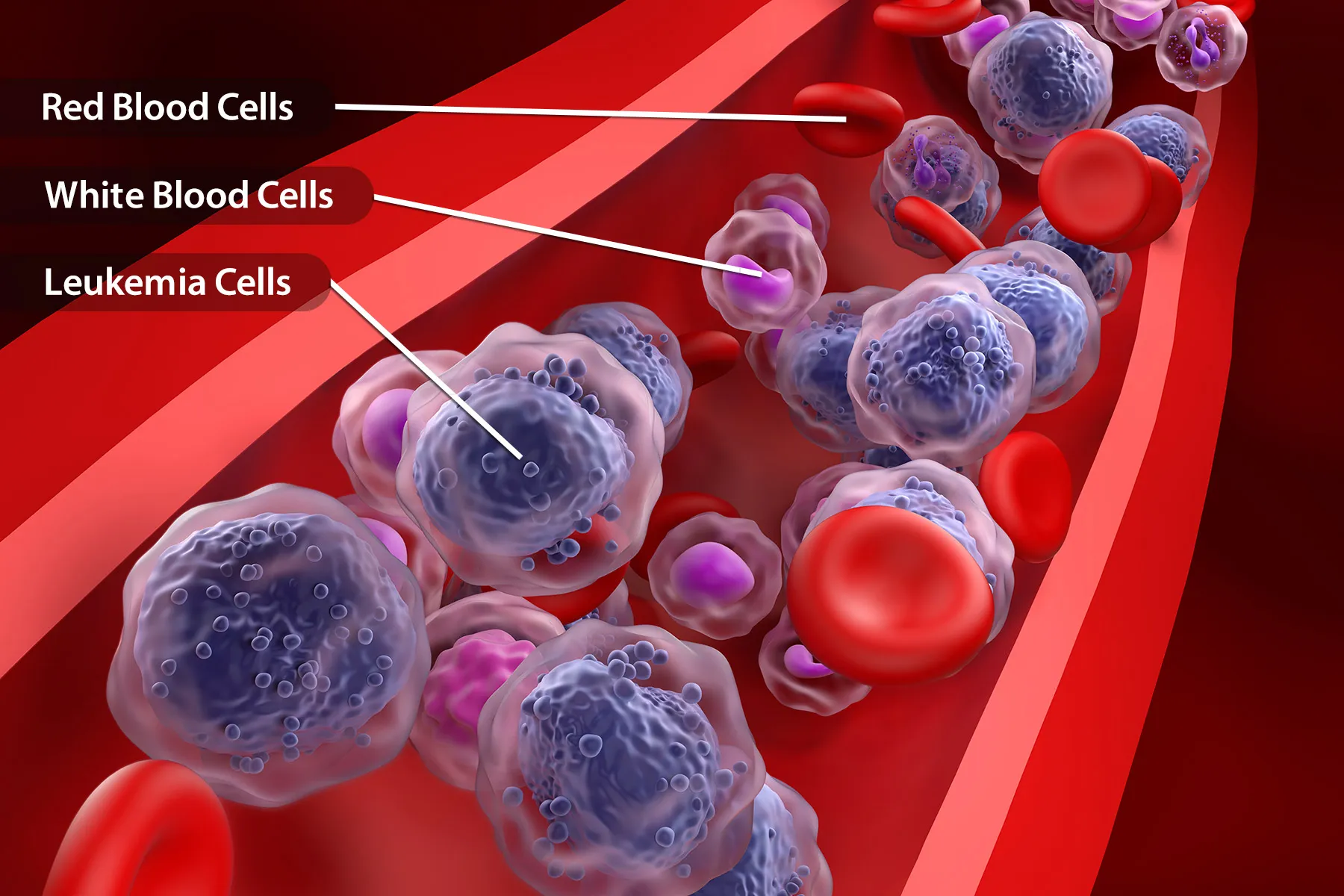 photo of leukemia cells in bloodstream