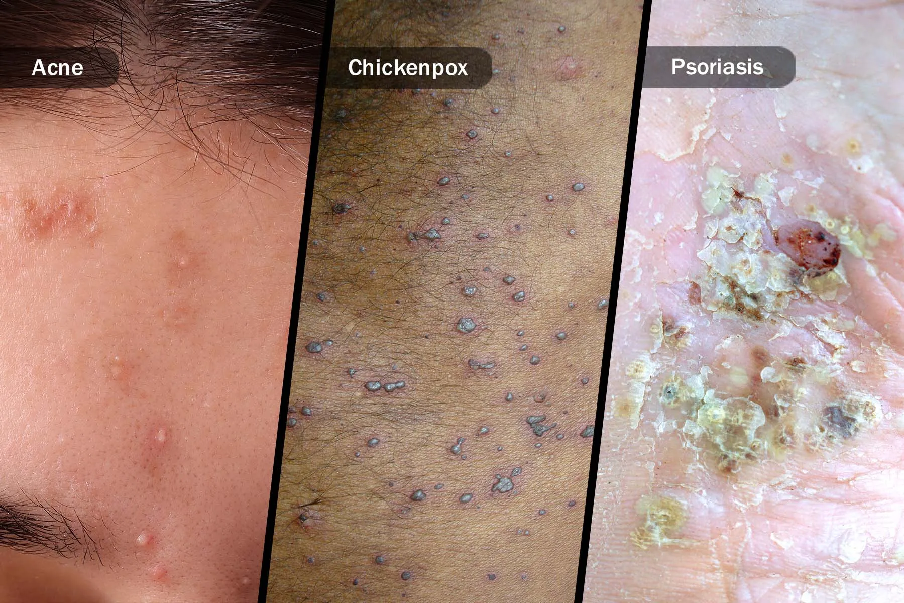 photo of pustules