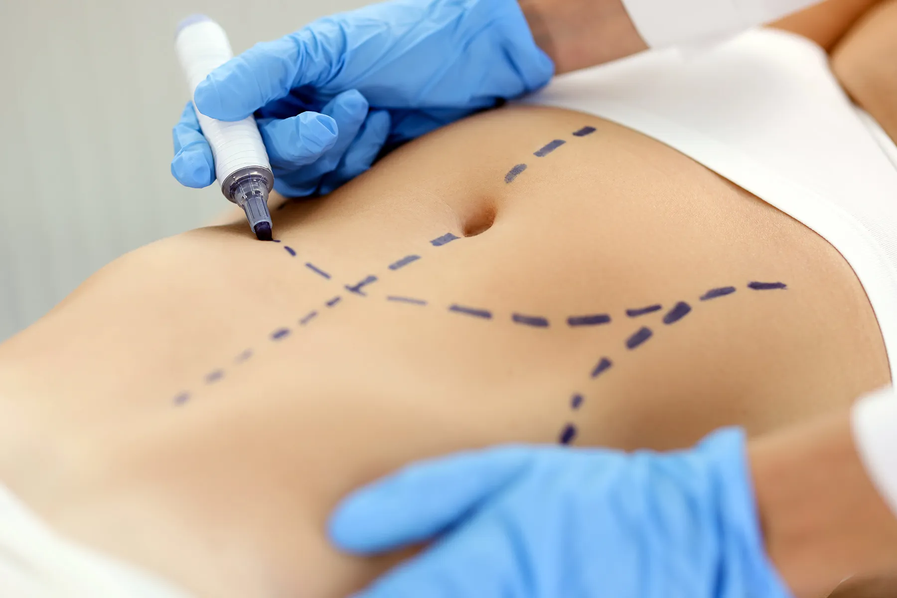 photo of surgeon marking abdomen for tummy tuck