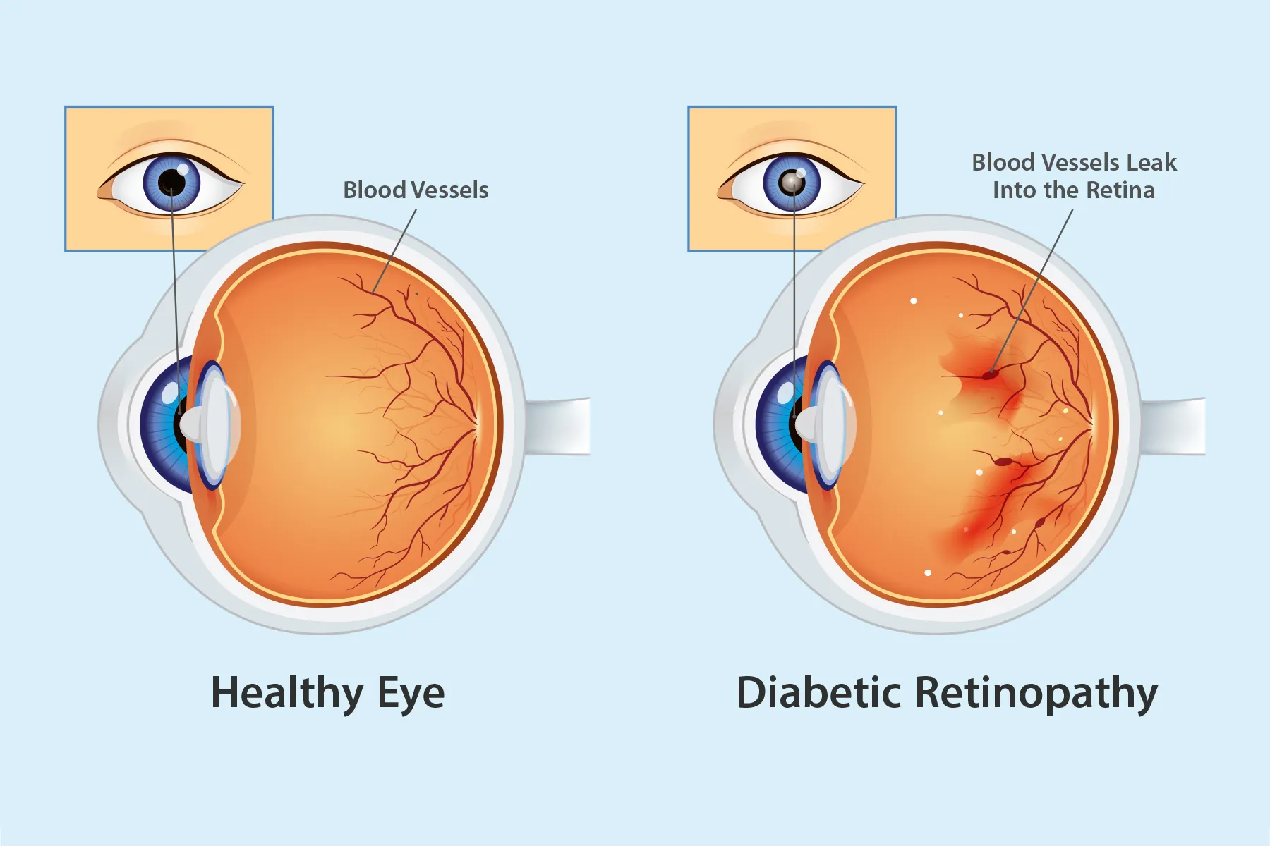 photo of normal eye vs diabetic retinopathy