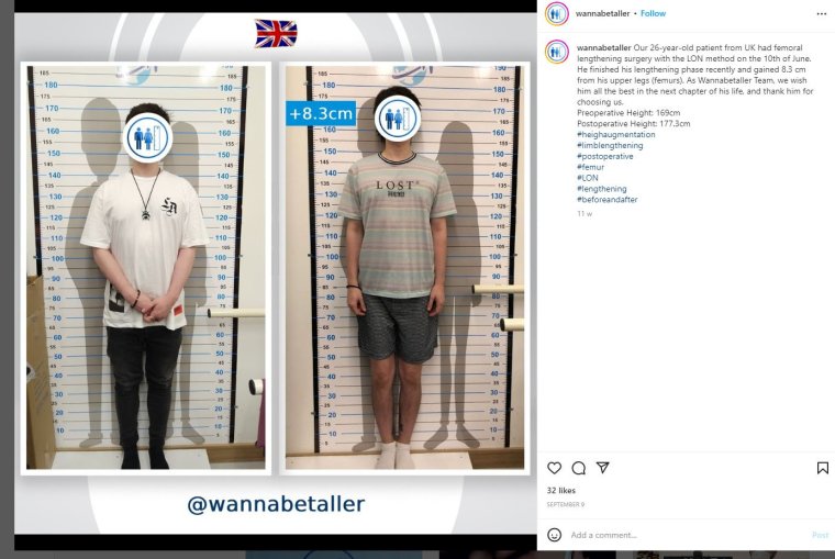 Images from the Instagram page for the Wanna Be Taller clinic in Turkey, which offers surgery to lengthen legs and increase height