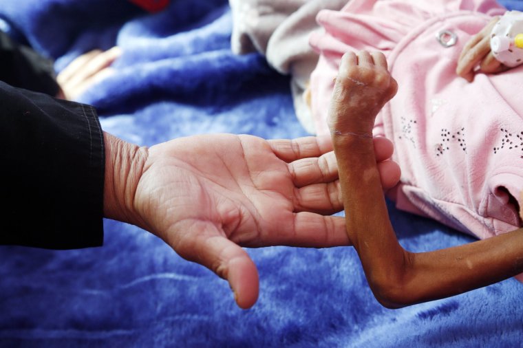 SANAA, YEMEN - DECEMBER 13: A Yemeni child, suffering from malnutrition, receives treatment with limited resources in the Department of Combating Malnutrition at Sabeen Hospital in Sanaa, Yemen on December 13, 2022. Millions of people will face hunger unless urgent action is taken in Yemen, which is in the grip of a humanitarian crisis brought on by a civil war that has lasted more than seven years, according to the United Nations Children's Fund (UNICEF). (Photo by Mohammed Hamoud/Anadolu Agency via Getty Images)