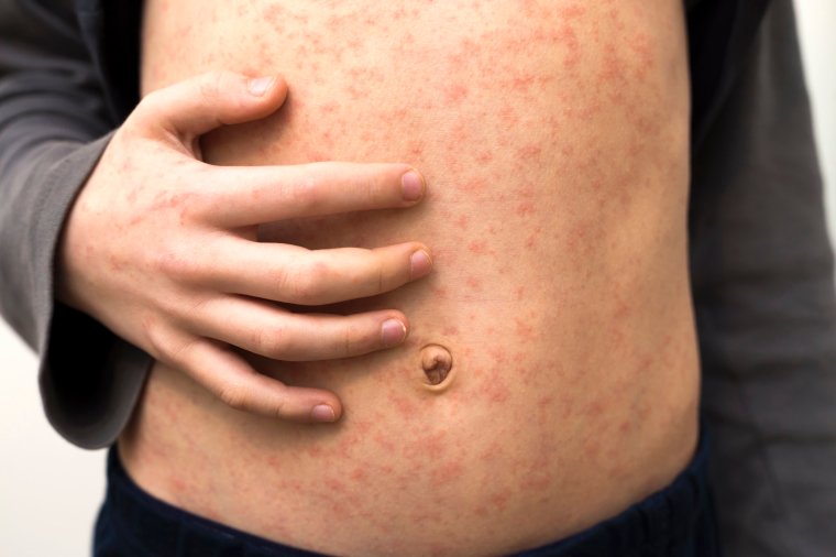 Sick child with red rash spots from measles.