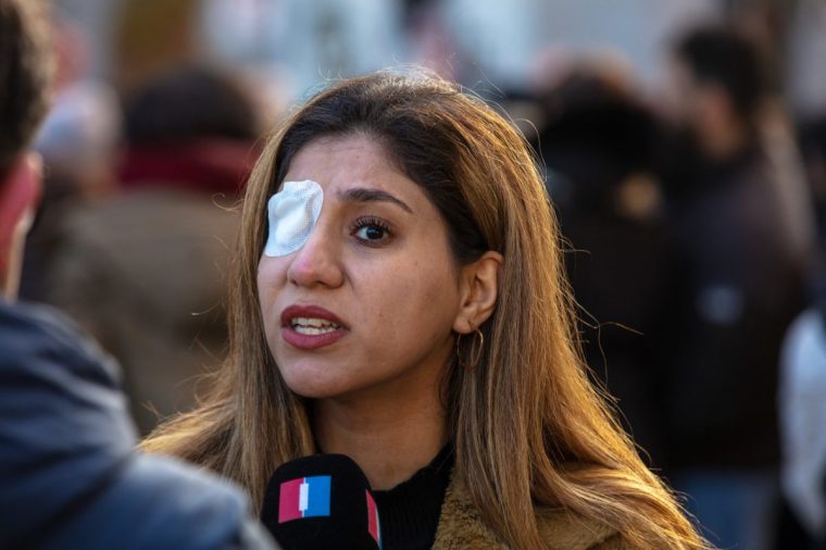 Kosar Eftekhari is one of the Iranian protesters who lost an eye after being shot by regime forces (Photo: ECHO IRAN / Middle East Images / AFP via Getty Images)