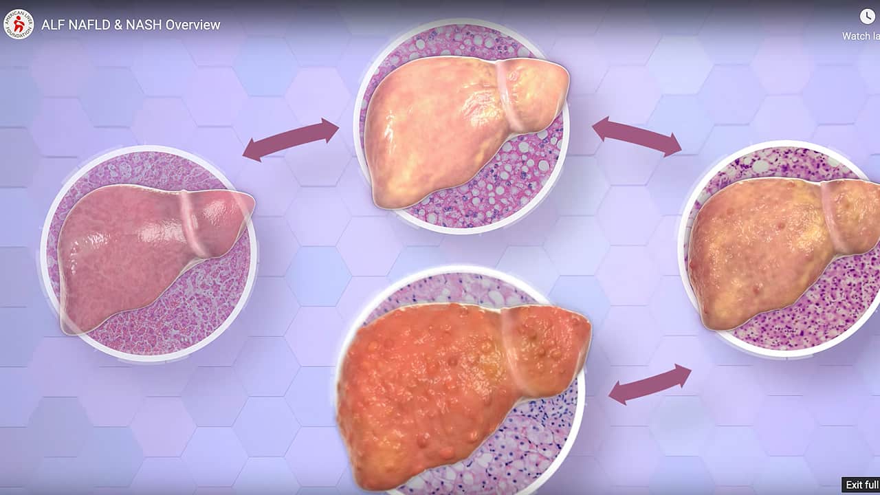 NAFLD & NASH Overview