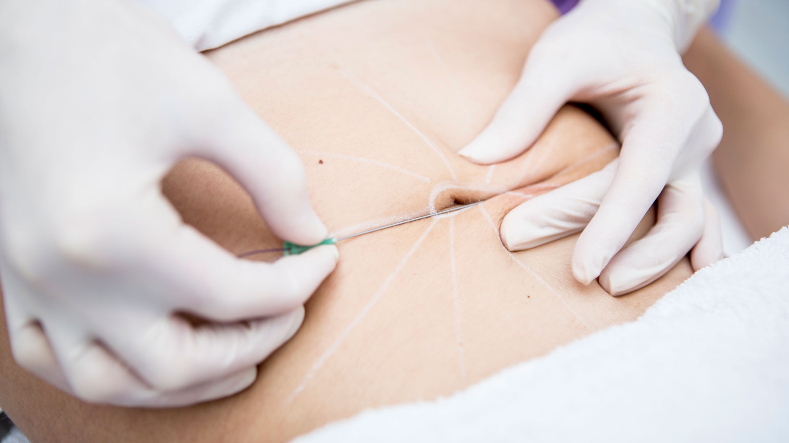 Doctor marking up patient's belly button before surgical procedure