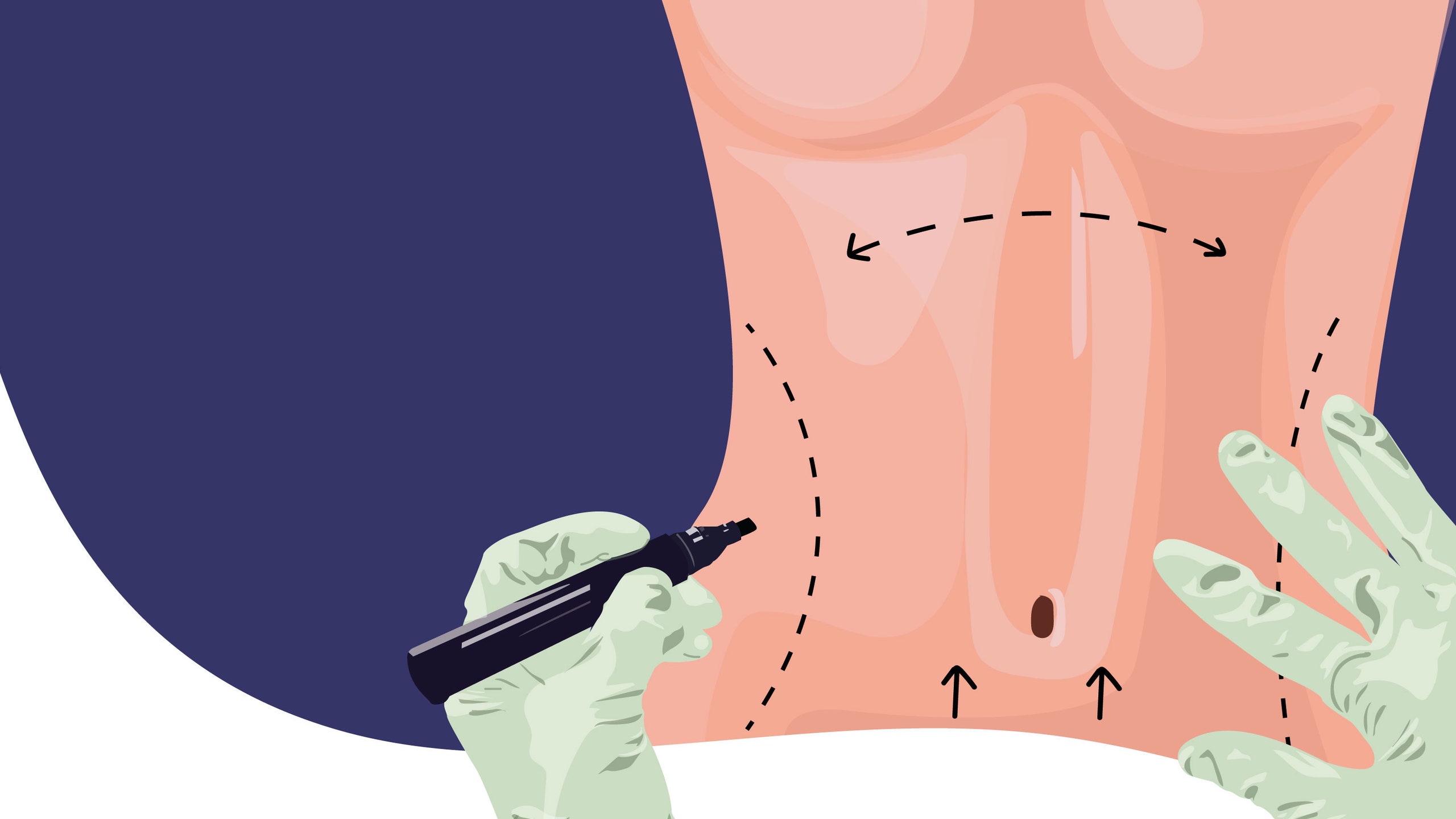 Life in Plastic column Tummy Tuck illustration A doctor's two hands marking up a person's body for a tummy tuck procedure