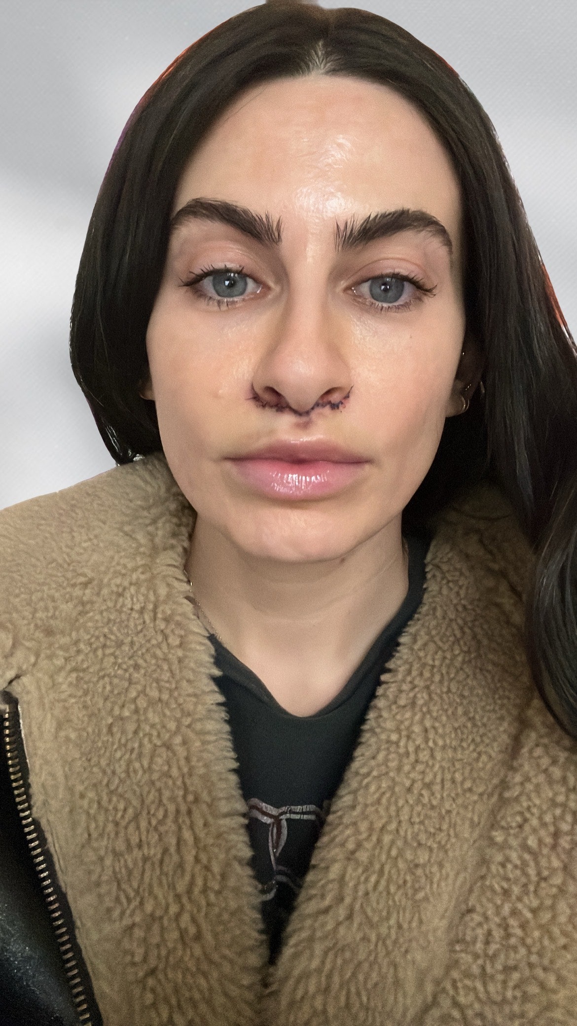 photo of taryn brooke four days post lip lift