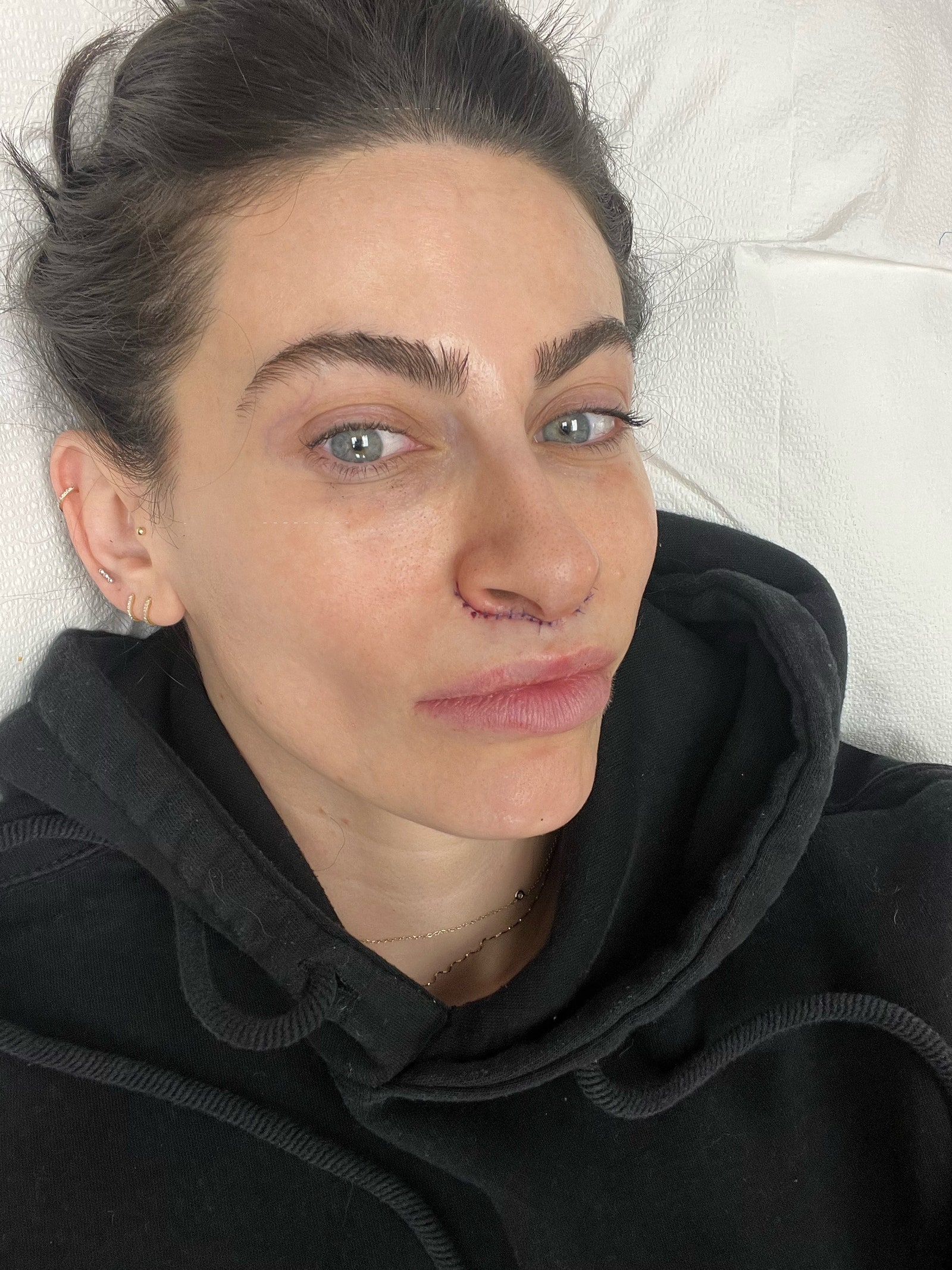 photo of taryn brooke 30 minutes after lip lift procedure