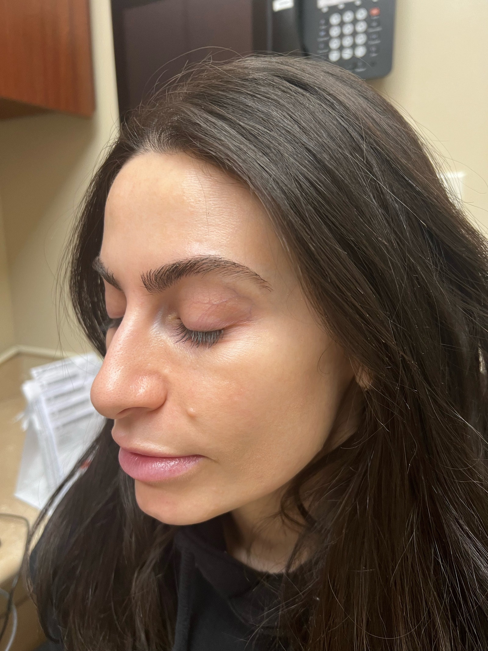 side angle of taryn brooke before lip lift procedure