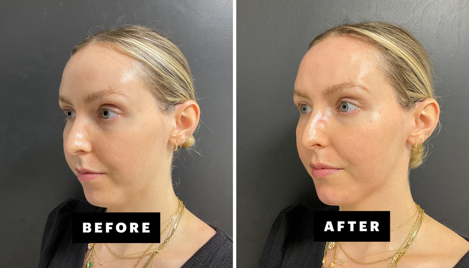 side by side images of woman before and after getting chin filler with black and white text on screen