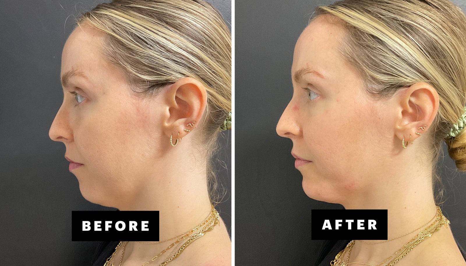 side by side images of woman before and after getting chin filler with black and white text on screen