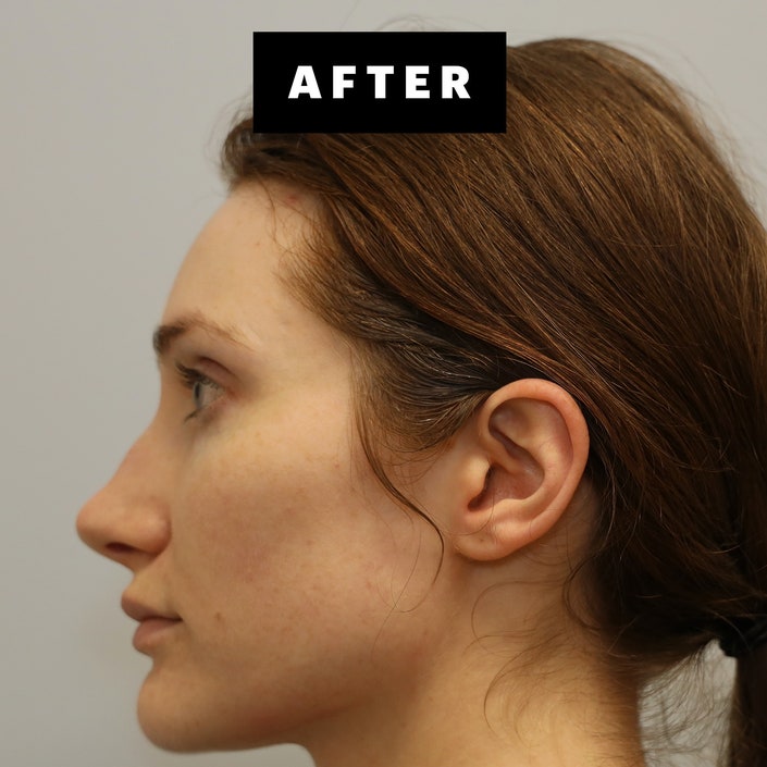 I Tried Forever Clear BBL Laser Treatment for My Chronic Acne