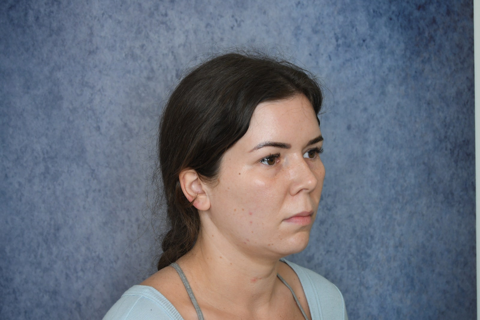 A woman before jawline liposuction she is shown with her head turned against a marbleized blue background