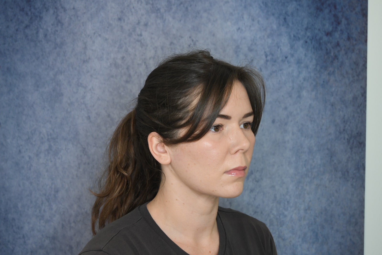 A woman after jawline liposuction she is shown with her head turned against a marbleized blue background