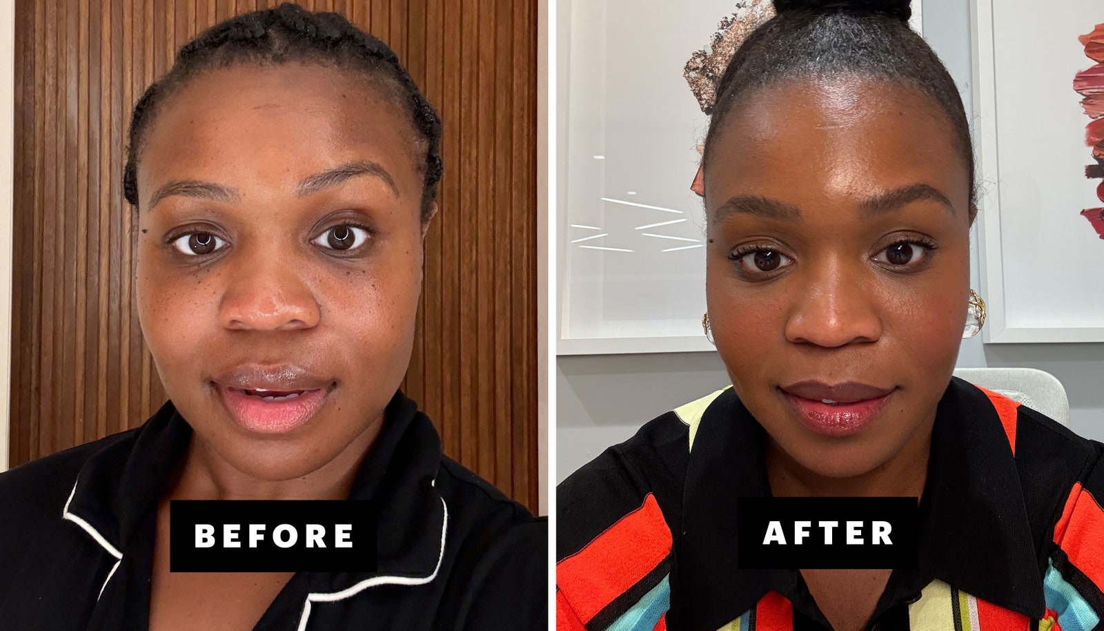 before and after images of woman after getting masseter botox treatment