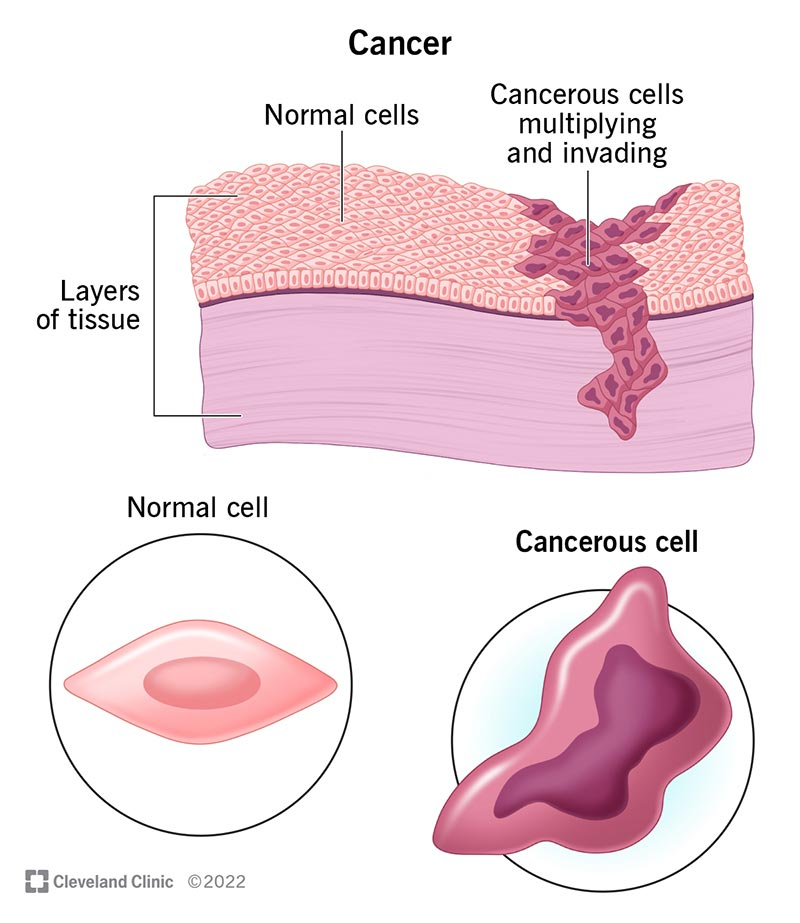 Cancerous cells multiplying and invading tissue, with normal cell and cancerous cell