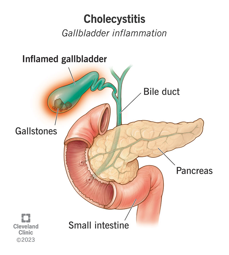 Cholecystitis is inflammation in your gallbladder, your storage organ for bile.