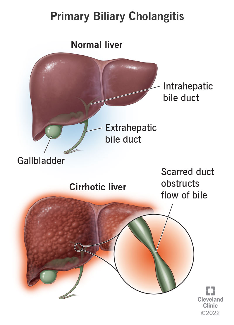 Illustration showing a normal liver and a cirrhotic liver.