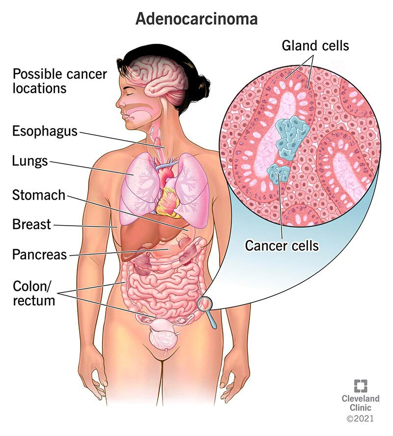 Adenocarcinoma, with possible cancer locations, like lungs, pancreas, stomach and colon