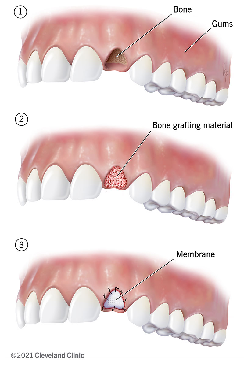 Mouth showing dental bone graft surgery