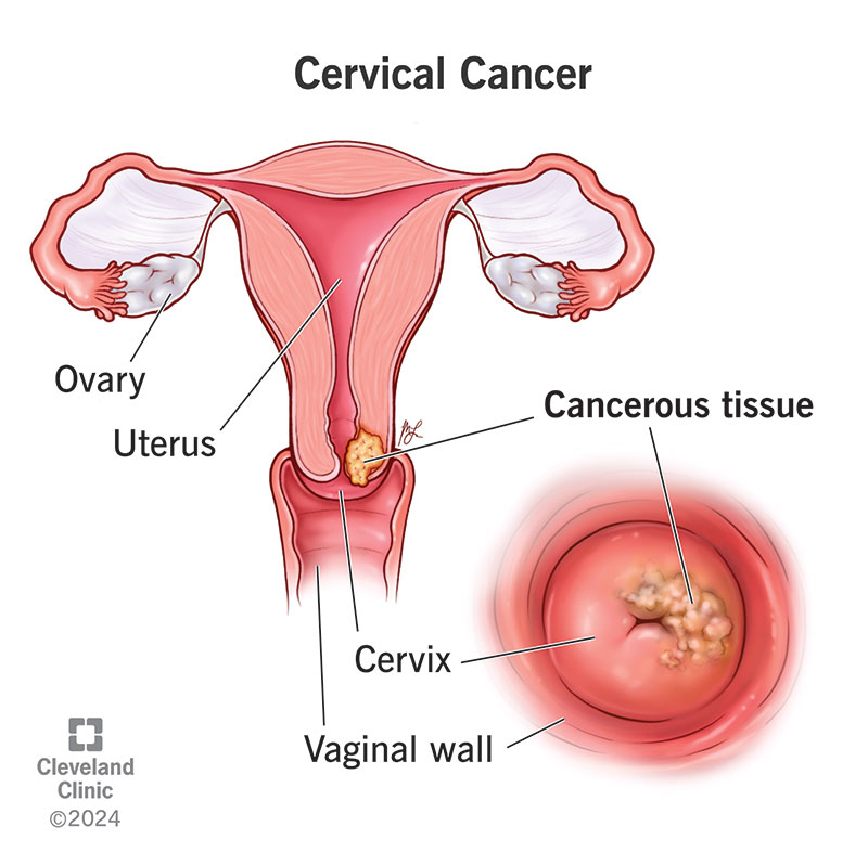 Cervical cancer, with cancerous tissue on the surface of the cervix