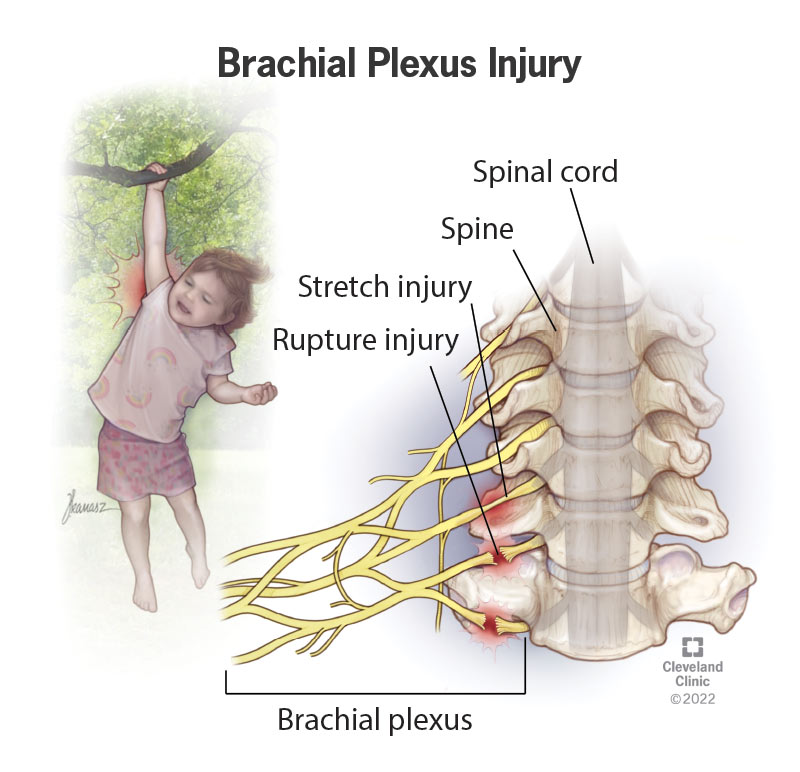 Illustration of a child hanging from a branch by one arm, with a closeup of a ruptured and stretched brachial plexus nerve