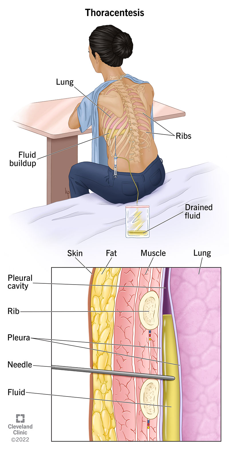 Cross-section of lungs during thoracentesis. Shows provider inserting needle into the pleural space to remove fluid.