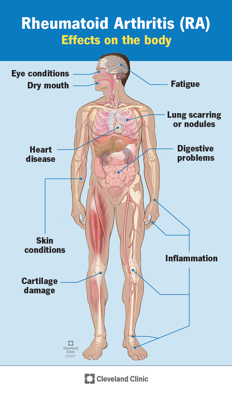 Rheumatoid arthritis affects the body with conditions like, heart disease, inflammation and fatigue