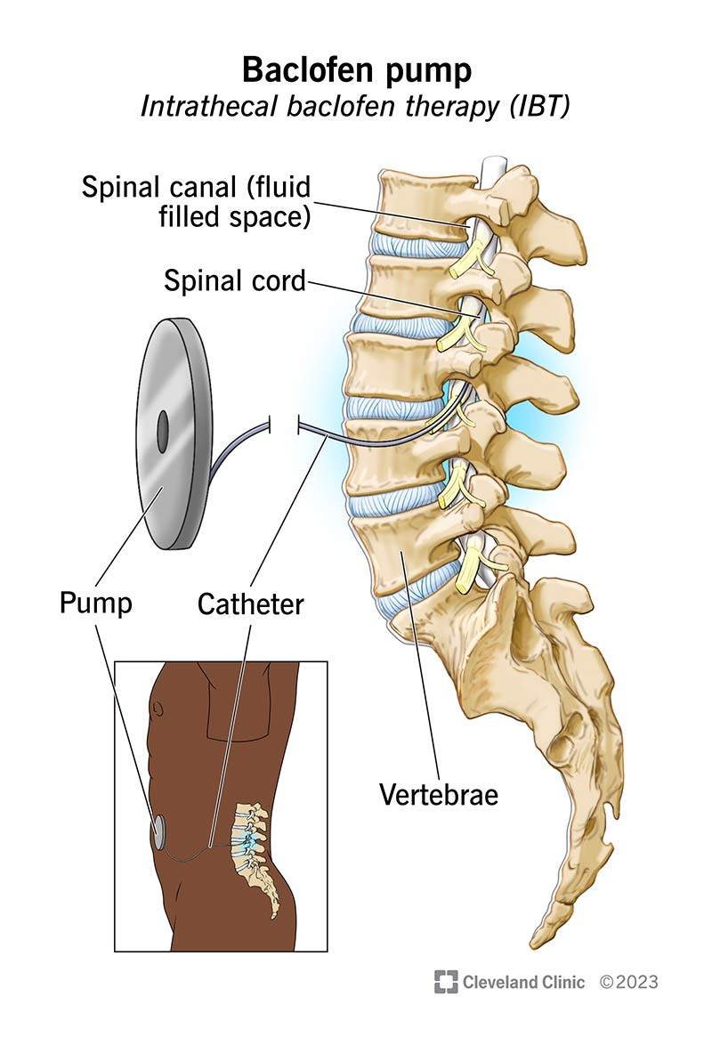 The components of a baclofen pump and their placement in the human body