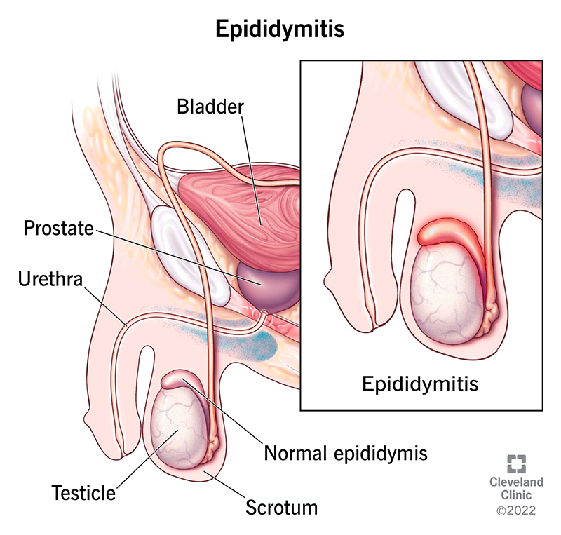 Epididymitis causes inflammation in the epididymis behind your testicle and can also cause pain in your scrotum and penis