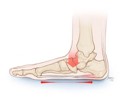 A flat foot’s bone structure, with little-to-no arch or sole