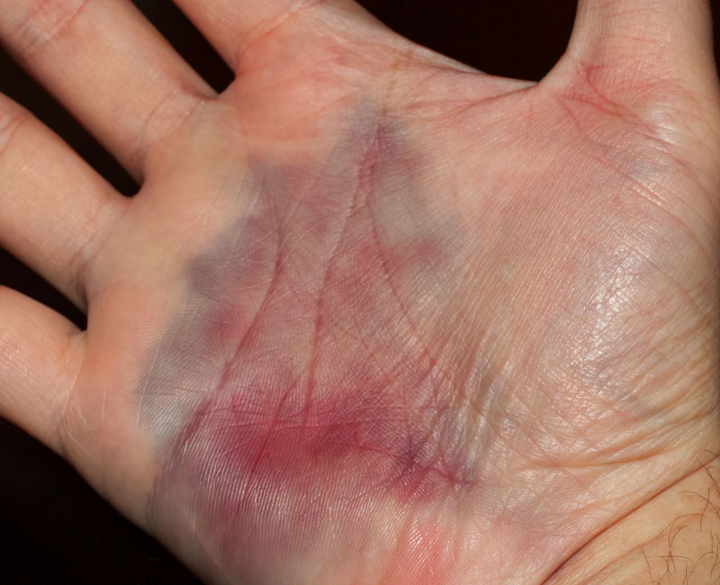 The color change from a bruise happens with a hematoma, a collection of pooled blood, visible through your skin