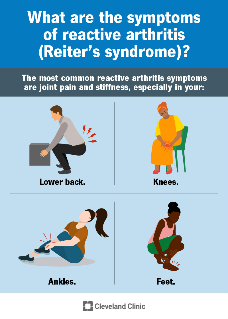 Reactive arthritis typically causes joint pain in your lower back, knees, ankles and feet