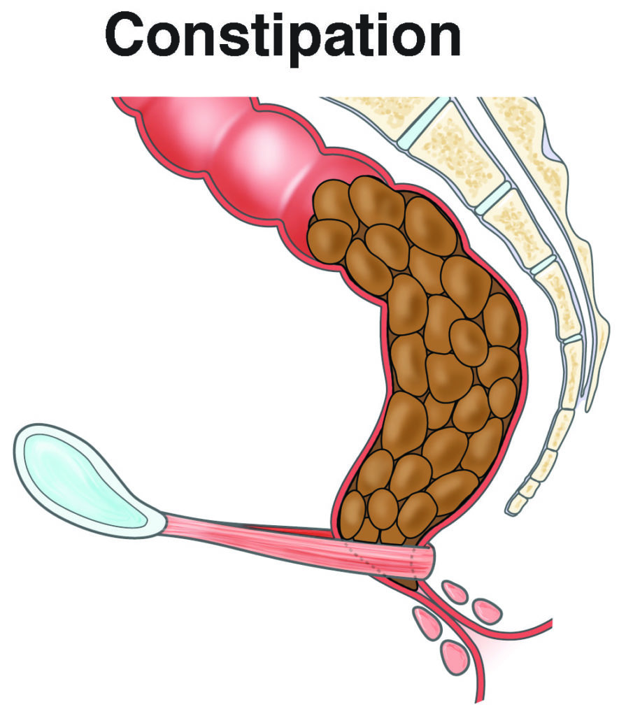 Constipation