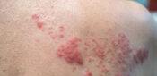 Shingles jab should be extended to over-80s and younger immunosuppressed