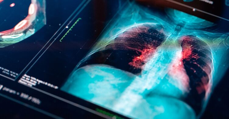 Ethnic and social inequalities in lung cancer diagnosis across England