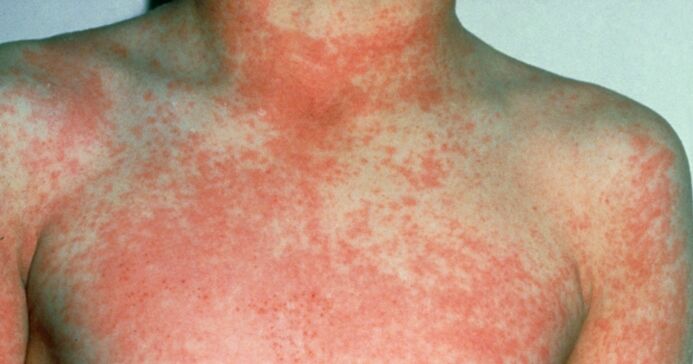 CPD – Case by case: Acute fever and rash in children