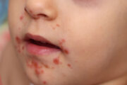 Speediatrics – what is the cause of this child’s facial rash?